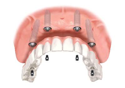 Dental Implants